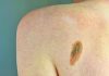 Imi: “Bene legge su prevenzione melanoma, educare i giovani su rischi”
