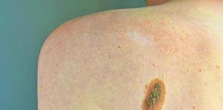 Imi: “Bene legge su prevenzione melanoma, educare i giovani su rischi”