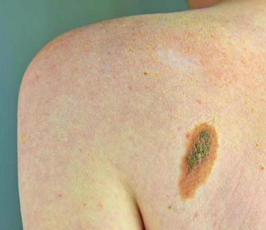 Imi: “Bene legge su prevenzione melanoma, educare i giovani su rischi”