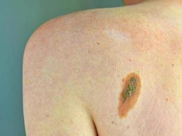 Melanoma, Adoi: “Bene nuova legge su prevenzione, dermatologo centrale in screening”