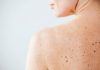 Nei e sole, Sidemast lancia la Giornata della prevenzione dermatologica