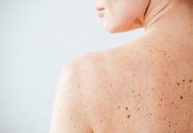 Nei e sole, Sidemast lancia la Giornata della prevenzione dermatologica