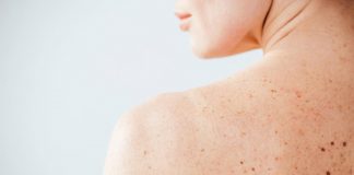 Nei e sole, Sidemast lancia la Giornata della prevenzione dermatologica