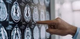 Centro Dbs Pavia, 100 interventi di neurostimolazione profonda per Parkinson