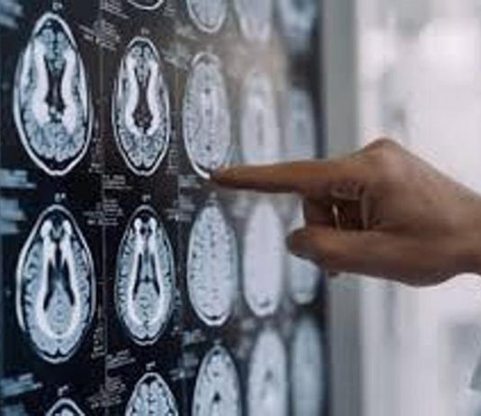 Centro Dbs Pavia, 100 interventi di neurostimolazione profonda per Parkinson