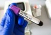 Tumore gastroesofageo Her2+, risultati positivi per tislelizumab con zanidatamab e chemio