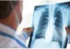 Cancro al polmone, approvato il rimborso di 2 nuove indicazioni per durvalumab