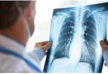 Cancro al polmone, approvato il rimborso di 2 nuove indicazioni per durvalumab