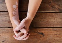 In Senato riflettori puntati sulla vitiligine, “luce su una malattia vittima di stigma, disinformazione e pregiudizi”