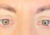 Visione annebbiata o distorta spia di retinopatia. “Ne soffre il 30% dei diabetici, prevenzione l’arma più efficace”