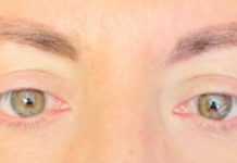 Visione annebbiata o distorta spia di retinopatia. “Ne soffre il 30% dei diabetici, prevenzione l’arma più efficace”