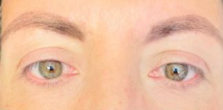 Visione annebbiata o distorta spia di retinopatia. “Ne soffre il 30% dei diabetici, prevenzione l’arma più efficace”