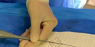 Fibrillazione atriale, Aou Marche: “Prima volta in Italia ablazione con catetere a campo pulsato”
