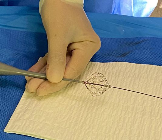 Fibrillazione atriale, Aou Marche: “Prima volta in Italia ablazione con catetere a campo pulsato”