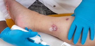 Idrosadenite suppurativa, le iniziative di Ucb per migliorare diagnosi e cura
