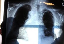 Bpco, pneumologa Foschino Barbaro: “Nella donna sintomi diversi, attenzione alle giovani”
