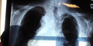 Bpco, pneumologa Foschino Barbaro: “Nella donna sintomi diversi, attenzione alle giovani”