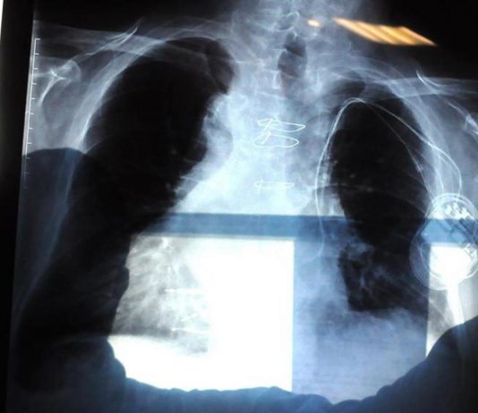 Bpco, pneumologa Foschino Barbaro: “Nella donna sintomi diversi, attenzione alle giovani”