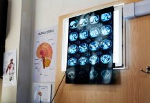 Di Battista, cosa indica un mal di testa forte e improvviso: le ipotesi del neurologo