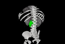 Chirurgia su misura, al Bambino Gesù di Roma rimosso complesso neuroblastoma a bimba di 1 anno