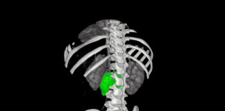 Chirurgia su misura, al Bambino Gesù di Roma rimosso complesso neuroblastoma a bimba di 1 anno