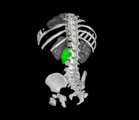 Chirurgia su misura, al Bambino Gesù di Roma rimosso complesso neuroblastoma a bimba di 1 anno