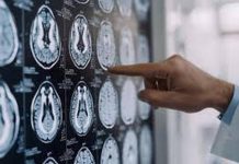Parkinson, in Italia 300mila persone malate: 10% ha diagnosi prima dei 50 anni