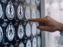 Parkinson, in Italia 300mila persone malate: 10% ha diagnosi prima dei 50 anni