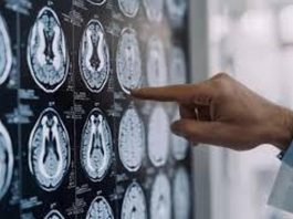Malattia di Parkinson, ok in Europa a formulazione orale Ld/Cd a rilascio modificato