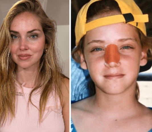 Chiara Ferragni, l’intervento al naso: “Ecco perché è storto ora”