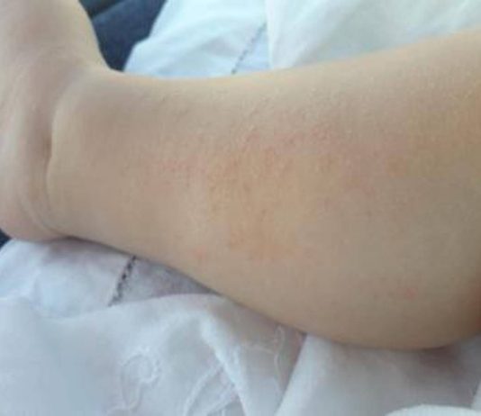 Dermatite atopica, Aifa estende rimborso di upadacitinib dai 12 anni di età
