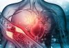 Arterosclerosi, studio: “Nuova molecola riduce di più il colesterolo cattivo”