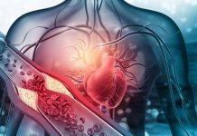 Arterosclerosi, studio: “Nuova molecola riduce di più il colesterolo cattivo”