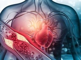 Arterosclerosi, studio: “Nuova molecola riduce di più il colesterolo cattivo”