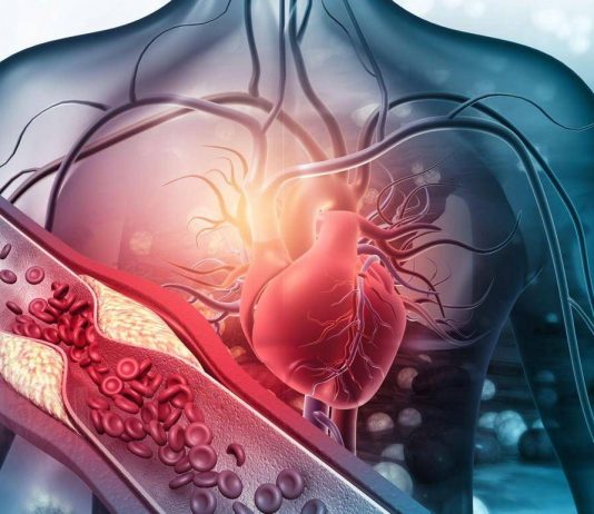 Arterosclerosi, studio: “Nuova molecola riduce di più il colesterolo cattivo”