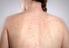 Morbillo, l’allarme dell’infettivologo Andreoni: “Casi in crescita, ricoveri frequenti negli adulti”