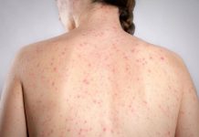 Morbillo, è allarme negli Usa. Italia prima per casi in Europa in in primi 6 mesi 2026