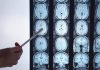 Di Battista e il tumore al cervello, in Italia circa 6mila diagnosi ogni anno: quali sono i sintomi ‘spia’