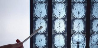 Di Battista e il tumore al cervello, in Italia circa 6mila diagnosi ogni anno