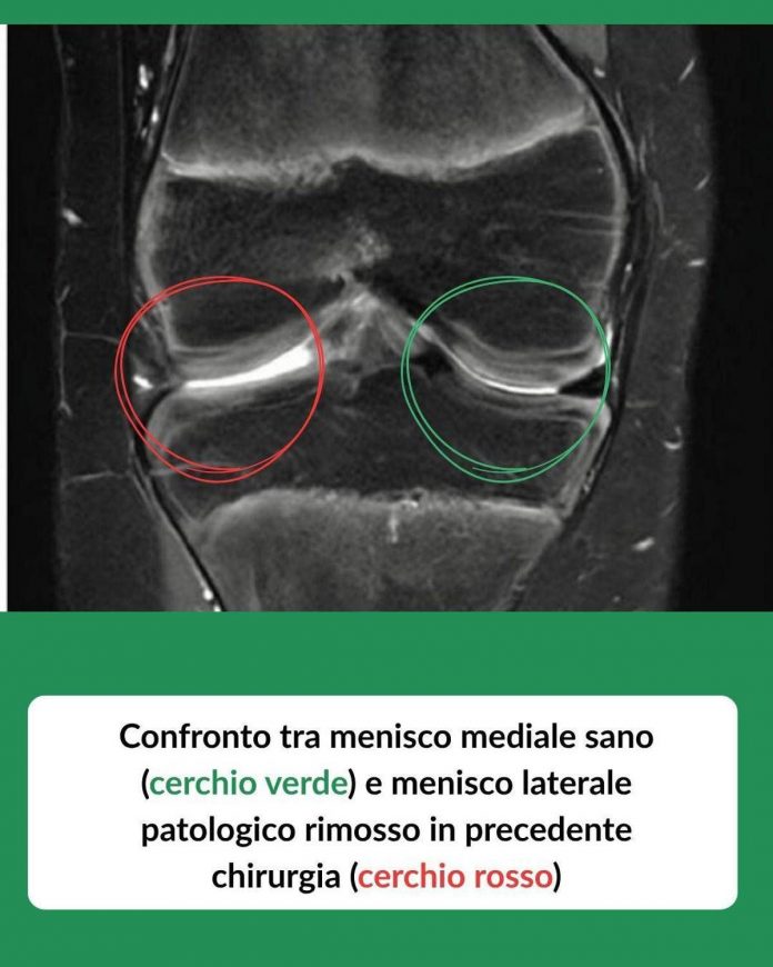 trapianto_menisco