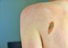 Melanoma, la firma mutazionale del cancro potrà cambiare la cura