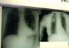 Cancro polmone, con nuova combinazione malattia sotto controllo più a lungo