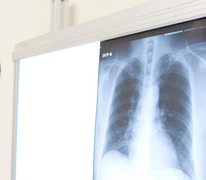 radiografia_polmone_123rf_free