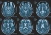 Una persona su 3 ha un disturbo neurologico, a Napoli arriva BrainSpace House