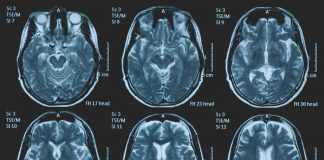 Una persona su 3 ha un disturbo neurologico, a Napoli arriva BrainSpace House